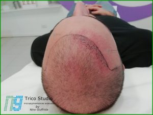 Tricopigmentazione Costi