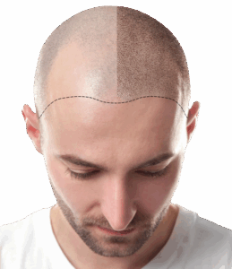 tricopigmentazione