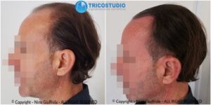 tricopigmentazione rinfoltimento - su capelli di lunghezza superiore 1 cm
