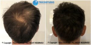 tricopigmentazione per zona diradata vertex - capello oltre 2 cm
