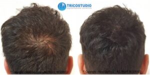 tricopigmentazione per zona diradata vertex - capello oltre 2 cm
