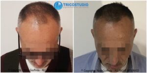 tricopigmentazione rinfoltimento - su capelli di lunghezza superiore 1 cm