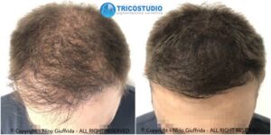 tricopigmentazione rinfoltimento - su capelli di lunghezza superiore 1 cm