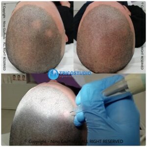 alopecia areata