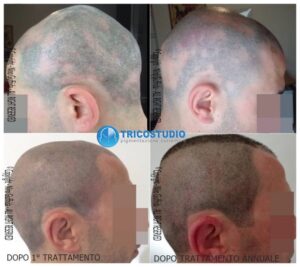 alopecia areata