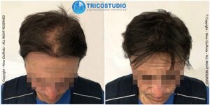 tricopigmentazione rinfoltimento - su capelli di lunghezza superiore 1 cm
