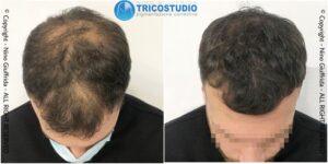 tricopigmentazione rinfoltimento - su capelli di lunghezza superiore 1 cm