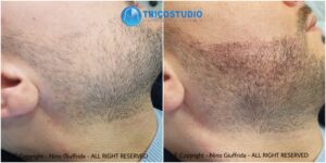 rinfoltimento barba