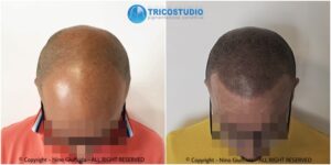 tricopigmentazione