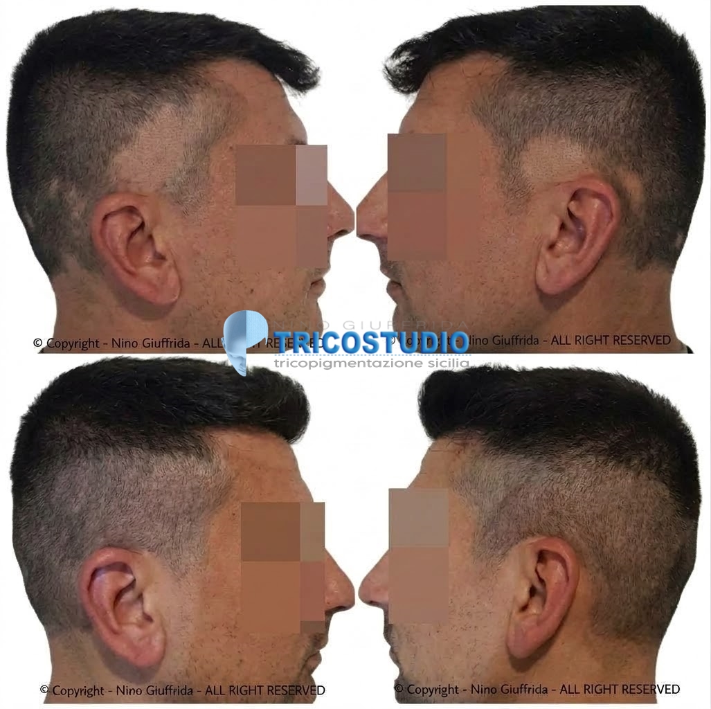 alopecia