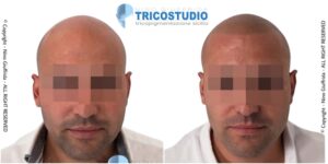 effetto rasato