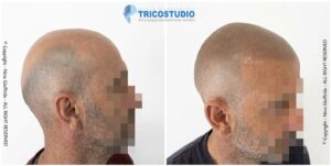 effetto rasato