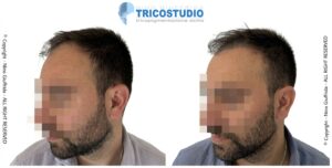 rinfoltimento