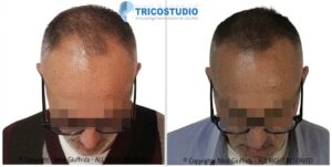 rinfoltimento