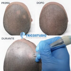 alopecia