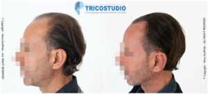rinfoltimento